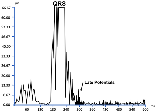Graph of ECG results occur during the QRS complex